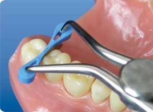 Cleste pentru aplicarea penelor elastice interdentare - imagine 2