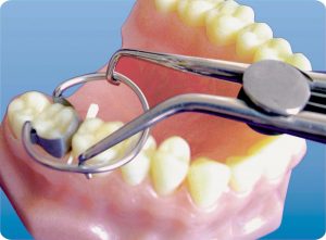 Cleste pentru aplicarea penelor elastice interdentare - imagine 4