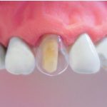 Coroane transparente cape celuloid set pt frontali adulti 64 buc - imagine 4