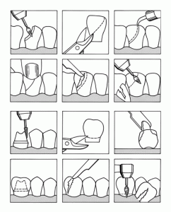 Coroane transparente cape pt frontali copii 64 buc - imagine 2